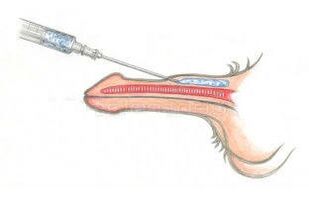 Penisi kalınlaştırmak için deri altına hyaluronik asit enjekte etmek