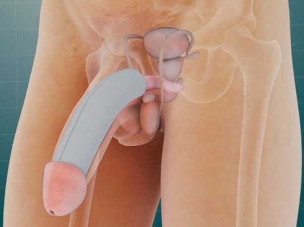 Deri altına özel bir implant yerleştirildikten sonra penis