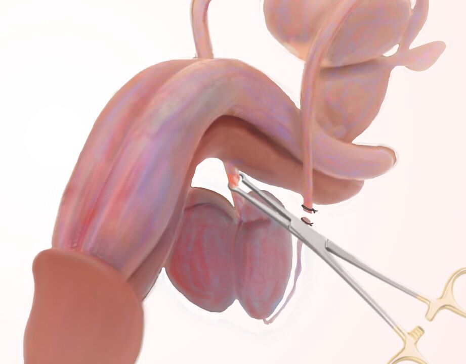 penis büyütme için ligamanotomi