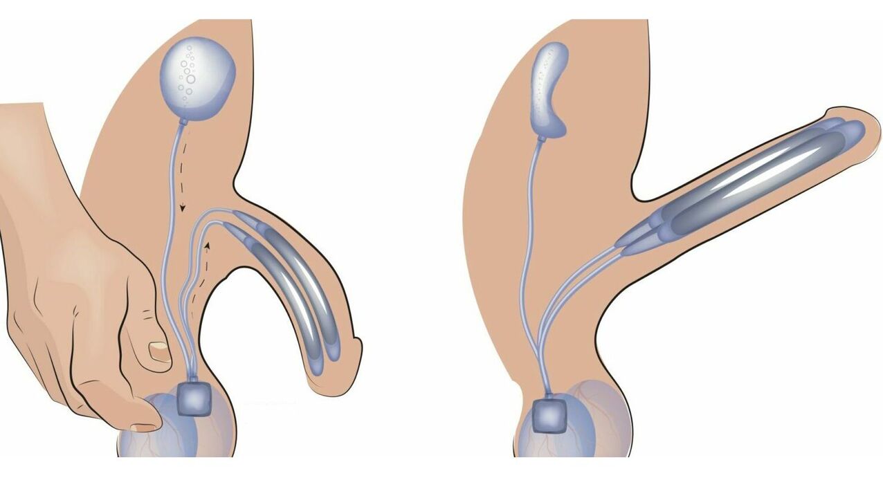 penis büyütme için penis protezi